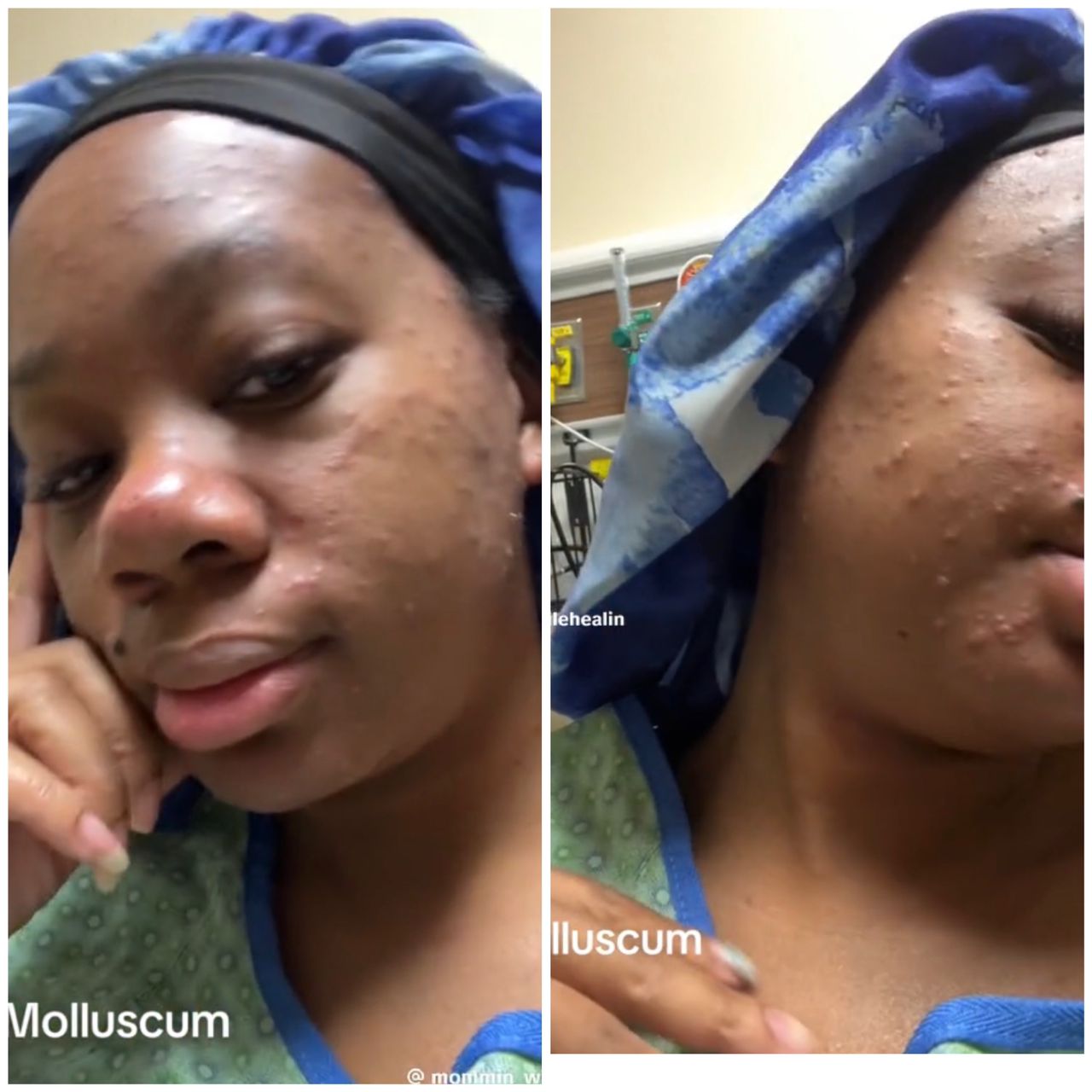 Lady claims she contracted Molluscum Contagiosum after purchasing a wig online (video)